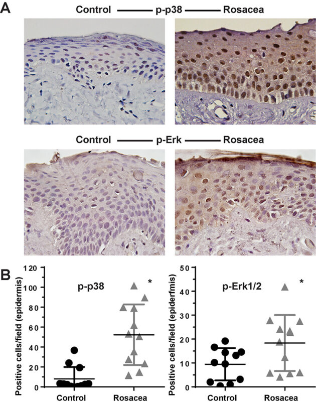 MAPKs-in-rosacea